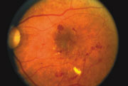 Una retina mostrando signos de enfermedad de la diabetes.
