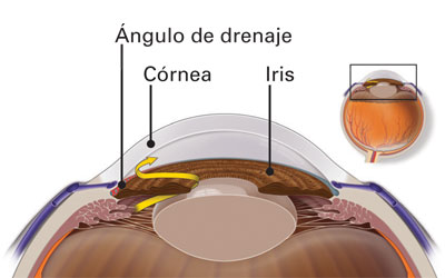 Si el ángulo de drenaje es bloqueado, el fluido no puede salir del ojo, causando un incremento en la presión.